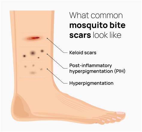 Effective Treatments for Mosquito Bite Scars | Healthnews