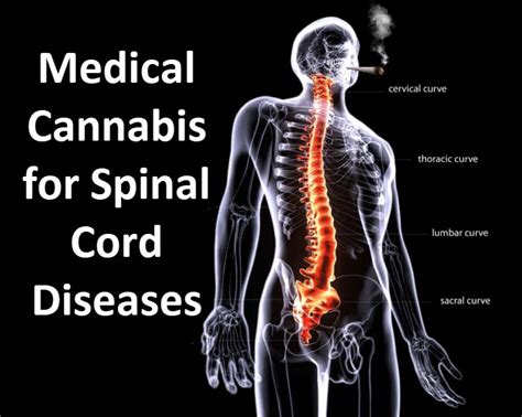 Medical Cannabis for Spinal Cord Diseases