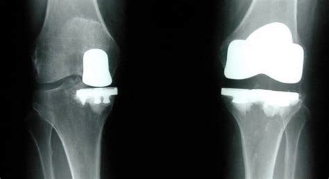 Unicompartmental vs total knee replacement - SMPL I Manufacturer