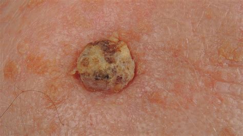 How Is Cutaneous Squamous Cell Carcinoma Treated?