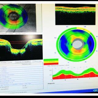 ONH (optic nerve head) | Download Scientific Diagram