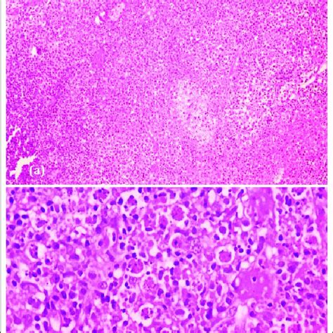 The excisional biopsies of cervical lymph nodes, show (a) Aggregates of ...