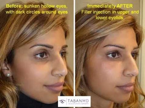 Sunken Eyes Dark Circles Eyelid Filler Injection-Before and After | (877) 697–5173 - YouTube