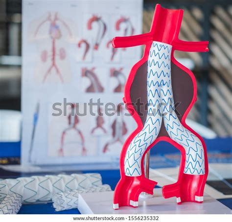 Best Evar Stent Graft Royalty-Free Images, Stock Photos & Pictures | Shutterstock