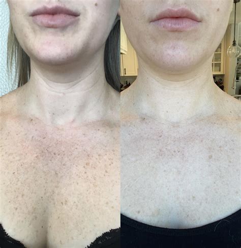 IPL Before and After Pictures Case 62 | Sacramento, CA | Destination ...