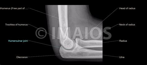 Joint - Cubital region - Radiographs - Anatomy : Humeroulnar joint, Humeroradial joint, Proxima ...