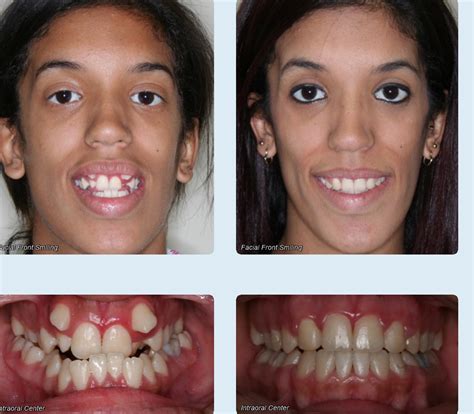 Before and After - Rodriguez Orthodontics | Hialeah FL