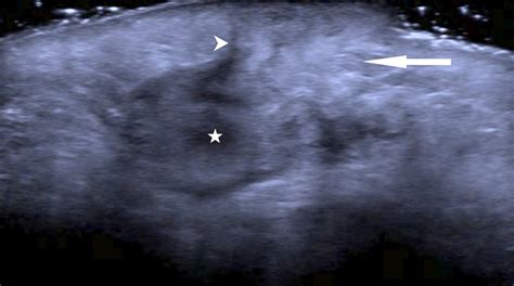 TB or not TB? The axillary lump question - Annals Singapore