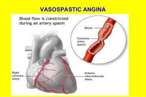 Chronic Stable Angina- Diagnosis & management