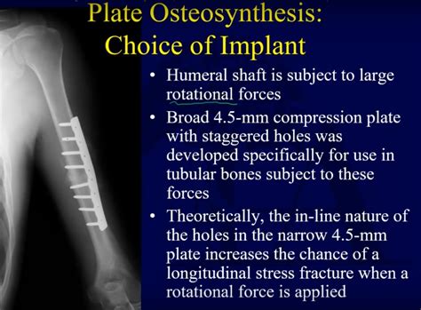 Surgical treatment of humeral shaft fractures — OrthopaedicPrinciples.com