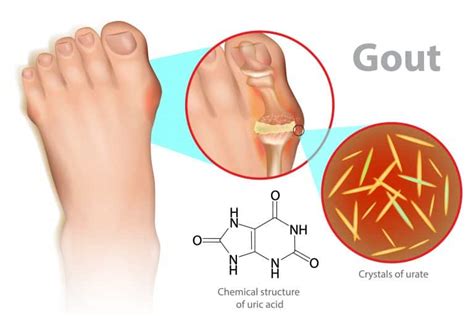 Gout Treatment & Symptoms Podiatrist near me- Beaver Valley Foot Clinic