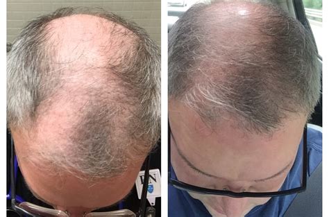 Non-surgical Hair Restoration: A New Results-Based Innovation | Canton ...