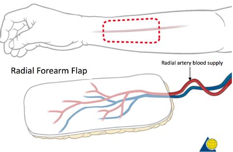 microsurgery-radial-forearm-flap- Dell Children's Craniofacial Team of Texas