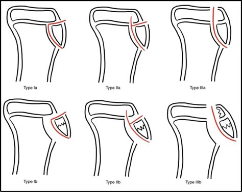 Tibial Tubercle Fracture