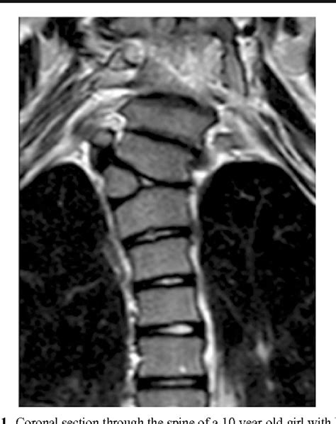 Hemivertebrae: a comprehensive review of embryology, imaging ...