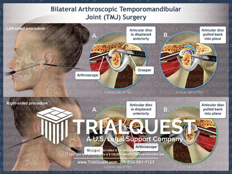 Bilateral Arthroscopic Temporomandibular Joint (TMJ) Surgery - Tr...