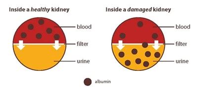 Albuminuria: Albumin in the Urine - NIDDK