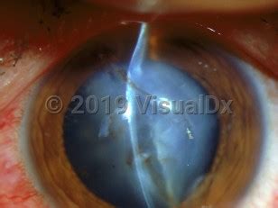 Corneal laceration