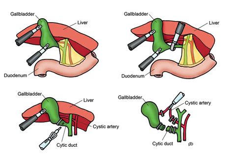 Abeezar Sarela | Gallstones | Laparoscopic Cholecystectomy