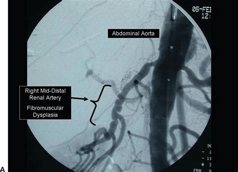 Renal Duplex Scanning | Thoracic Key