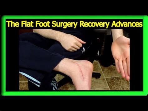 Flat Foot Surgery Recovery: Weeks 7-9 - YouTube