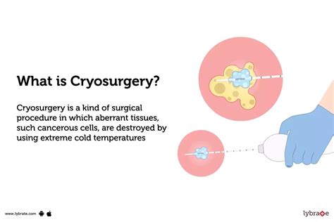 Cryosurgery: Purpose, Procedure, Benefits and Side Effects