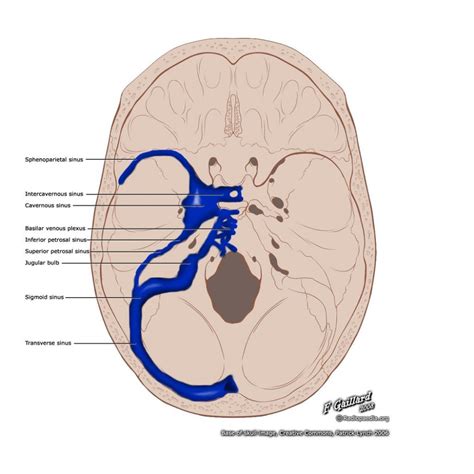 Dural venous sinuses (illustration) | Radiology Case | Radiopaedia.org ...