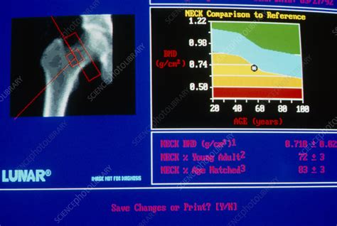 Bone density scan result in osteoporosis - Stock Image - M230/0130 ...