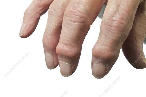 Osteoarthritis of the hand - Stock Image - C010/3320 - Science Photo Library