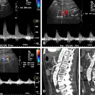 Tardus Parvus waveform in a 90-year-old male with significant stenosis... | Download Scientific ...