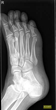 Avulsion fracture of the cuboid | Image | Radiopaedia.org