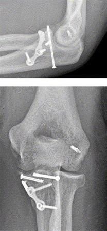 Coronoid Process Of Ulna Fracture