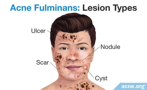 What Is Acne Fulminans? - Acne.org