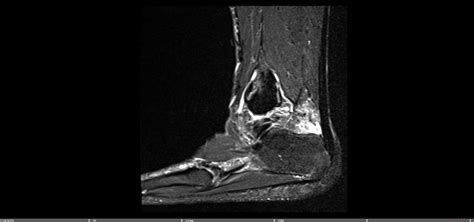 Insertional Achilles Calcific Tendonitis — Chicago Foot & Ankle Orthopaedic Surgeons