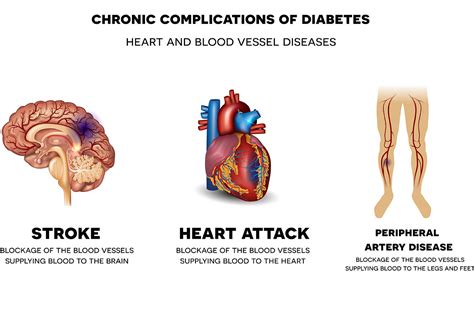 Diabetes & Macrovascular Diseases - Apollo Sugar Clinics