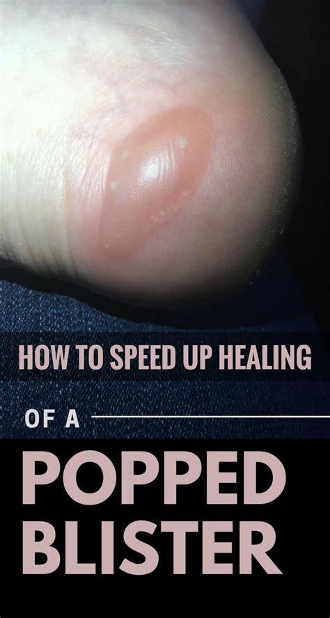 How to Speed Up Healing of a Popped Blister | Blister treatment, Blister remedies, Health and ...