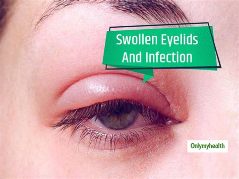 Swollen shut black eye: Black eye (periorbital haematoma) – treatment ...