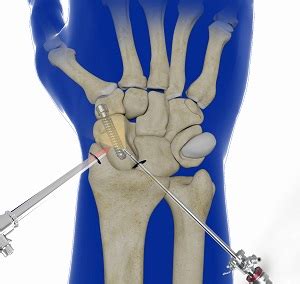 Arthroscopic Partial Wrist Fusion Overland Park | Wrist Joint Pain Kansas City