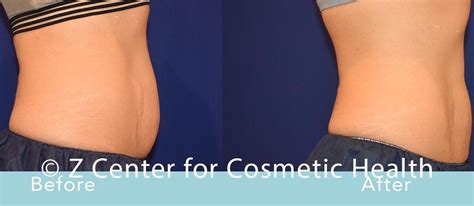 Coolsculpting Abdomen Before & After #36 - Zcosmetic Health