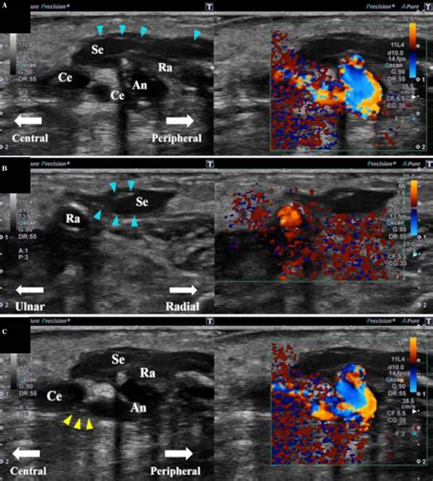 Figure 2 from Seroma as a Rare Complication of Autologous Arteriovenous Fistula Creation in the ...