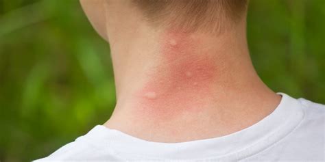 Mosquito Bite Allergy Symptoms - Mosquito Bite Reaction Meaning