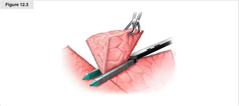 Open Wedge Resection | Thoracic Key