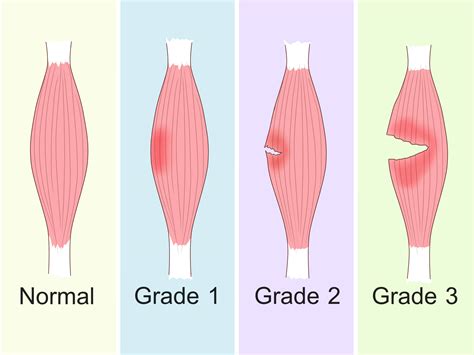 Quad Strain: Symptoms, Treatment, and Prevention