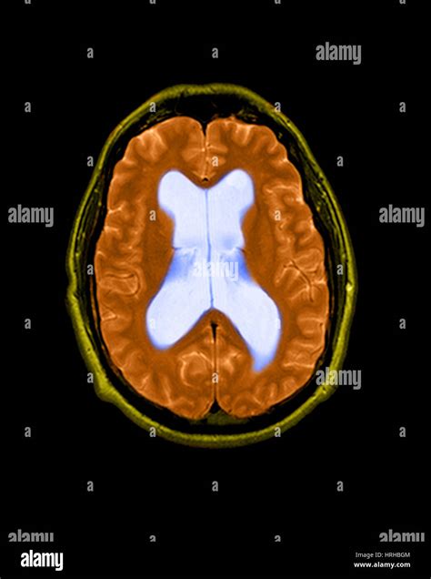 Mri of hydrocephalus hi-res stock photography and images - Alamy