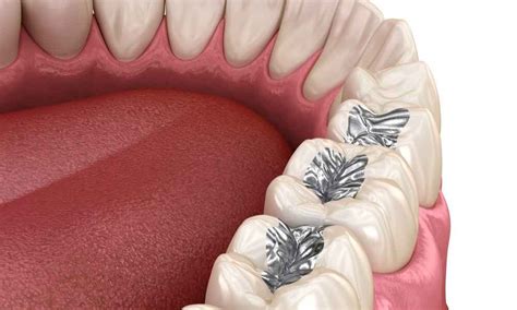 Amalgam Fillings: What you need to know?