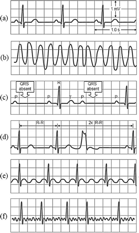 Common examples of abnormal ECGs [11]; (a) normal sinus rhythm; (b)... | Download Scientific Diagram