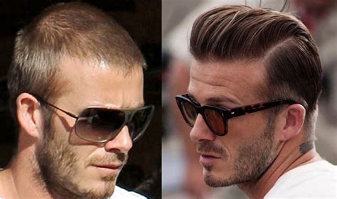 David Beckham Hair Transplant | Hold the Hairline