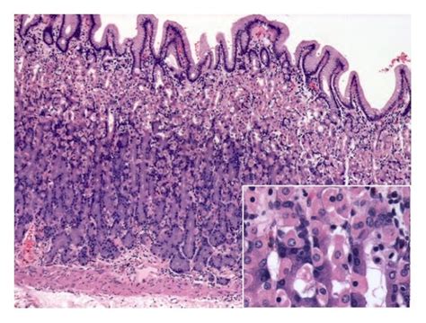 Gastric Ulcer Histology