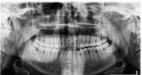 Orthopantomogram shows no evidence of fracture. | Download Scientific ...