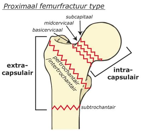 Extracapsulaire fractuur · Wolk